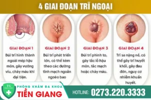 Mách bạn địa điểm điều trị trĩ ngoại hiệu an toàn hiệu quả tại Tiền Giang