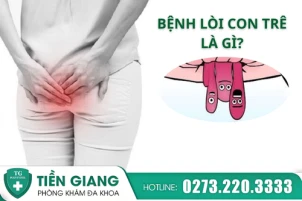 Bệnh lòi con trê là gì? Những điều ai cũng nên biết để tránh biến chứng nguy hiểm