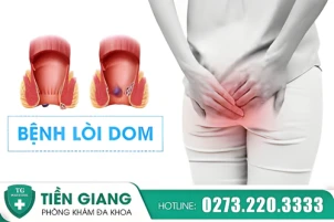 Cảnh báo: Lòi dom hậu môn nếu chủ quan có thể gây biến chứng