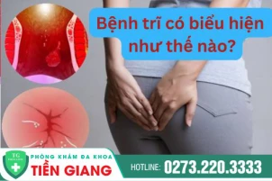 Bệnh trĩ có biểu hiện như thế nào? Cách điều trị hiệu quả, an toàn
