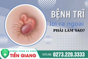 Bệnh Trĩ Lòi Ra Ngoài Phải Làm Sao? Phương Pháp Làm Teo Búi Trĩ