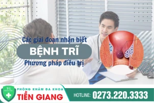 Bệnh Trĩ Là Gì? Nhận Biết Các Giai Đoạn Của Bệnh Trĩ Và Cách Điều Trị Phù Hợp
