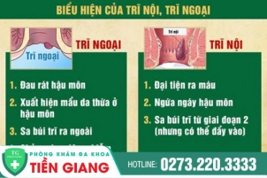 Bệnh Trĩ Thường Có Dấu Hiệu Gì? Cách Nhận Biết Và Điều Trị