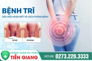 Tìm hiểu các phương pháp điều trị trĩ hiệu quả, an toàn hiện nay