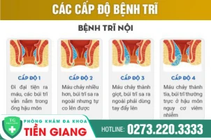 Tìm hiểu phương pháp và địa điểm điều trị trĩ nội uy tín