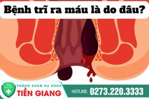 Bệnh trĩ ra máu phải làm sao? Cách điều trị an toàn, hiệu quả