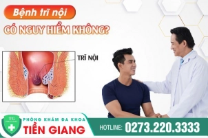 Cách Điều Trị Trĩ Nội Hiệu Quả - Tin Vui Cho Người Mắc Bệnh Trĩ