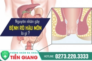Bệnh Rò Hậu Môn Và Cách Chữa An Toàn Hiệu Quả