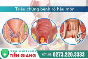 Không Nên Chủ Quan Với Các Triệu Chứng Bệnh Rò Hậu Môn