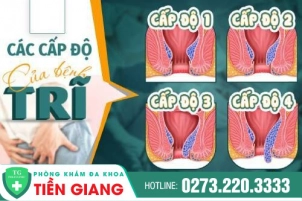 Bệnh Trĩ Có Biểu Hiện Thế Nào Qua Từng Giai Đoạn? Nhận Biết Sớm Điều Trị Kịp Thời
