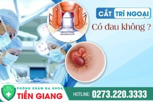 Có Nên Cắt Trĩ Ngoại Không? Thời Điểm Nào Nên Cắt Trĩ?