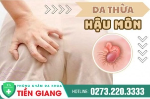 Phương Pháp Phẫu Thuật Cắt Da Thừa Hậu Môn Tiết Kiệm Chi Phí