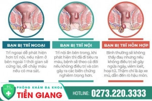 Dấu Hiệu Và Cách Chữa Bệnh Trĩ Nhẹ Giai Đoạn Đầu