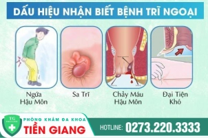 Hướng Dẫn Cách Nhận Biết Bệnh Trĩ Ngoại Và Phương Pháp Điều Trị Hiệu Quả