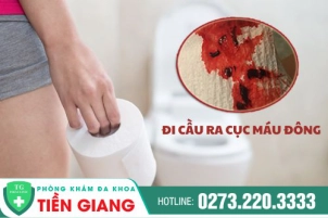 Đi Cầu Ra Cục Máu Đông Là Bệnh Gì? Nguyên Nhân, Tác Hại Và Cách Điều Trị