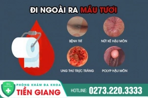Hiện Tượng Đi Ngoài Ra Máu Tươi Là Dấu Hiệu Của Bệnh Gì? Khắc Phục Như Thế Nào?