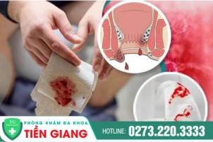 Bệnh đi ngoài ra máu tươi có nguy hiểm không? Cách điều trị hiệu quả