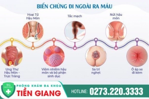Lo Lắng Vì Đi Cầu Có Máu? Dấu Hiệu Mắc Bệnh Hậu Môn Trực Tràng
