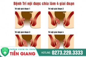 Tìm Hiểu Các Dấu Hiệu Nhận Biết Trĩ Nội Theo Từng Giai Đoạn