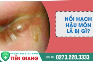 Hạch Hậu Môn Là Dấu Hiệu Nhiều Bệnh Lý Nguy Hiểm