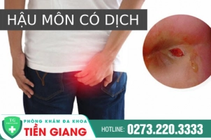 Hậu Môn Có Dịch Phải Làm Sao? Nguy Hiểm Thế Nào Nếu Không Điều Trị Kịp Thời