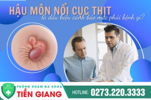 Hậu Môn Nổi Cục Có Sao Không? Xem Ngay Phương Pháp Điều Trị Hiệu Quả