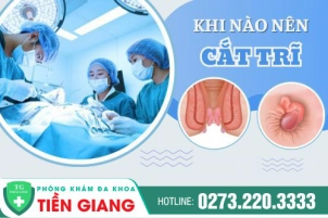 Người Bị Bệnh Bị Trĩ Giai Đoạn Mấy Nên Phẫu Thuật? Phương Pháp An Toàn Hiện Nay