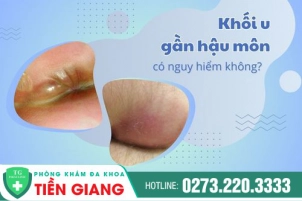 Xuất Hiện Khối U Gần Hậu Môn - Dấu Hiệu Không Nên Chủ Quan