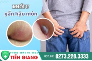 Khối U Ở Hậu Môn - Dấu Hiệu Sức Khỏe Gặp Vấn Đề