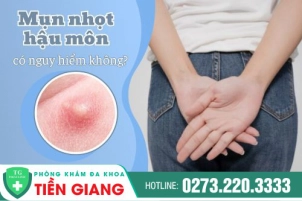 Mụn Nhọt Hậu Môn Bị Bể Có Nguy Hiểm Không? Nên Điều Trị Khi Phát Hiện Sớm