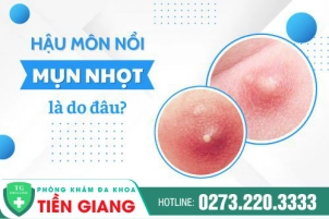Mụn Nhọt Hậu Môn Là Gì? Cùng Tìm Hiểu Xem Những Thói Quen Hằng Ngày Gây Ra Nhọt Hậu Môn
