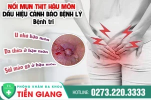 Mụn Thịt Hậu Môn Là Bệnh Gì? Tư Vấn Miễn Phí Cùng Bác Sĩ Chuyên Khoa
