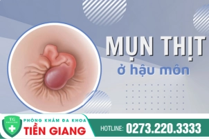 Hậu Môn Nổi Mụn Thịt Là Dấu Hiệu Của Bệnh Gì, Cùng Bác Sĩ Chuyên Khoa Giải Đáp Thắc Mắc Và Chữa Trị Kịp Thời