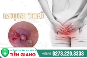 Mụn Trĩ Có Nguy Hiểm Không? Nên Điều Trị Như Thế Nào?