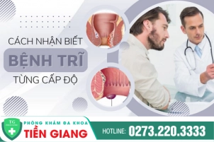 Cách Nhận Biết Bệnh Trĩ Chính Xác Theo Từng Cấp Độ