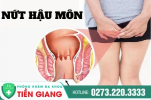 Tìm hiểu nguyên nhân nứt hậu môn và phương pháp điều trị hiệu quả