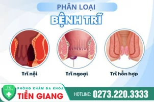 Các giai đoạn của bệnh trĩ và cách trị bệnh trĩ hiệu quả