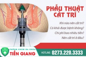 Có Nên Cắt Trĩ Không? Phương Pháp Cắt Trĩ Hiệu Quả Hiện Nay