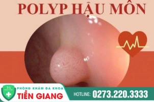 Đã Có Phương Pháp Điều Trị Polyp Hậu Môn Với Công Nghệ Hiện Đại