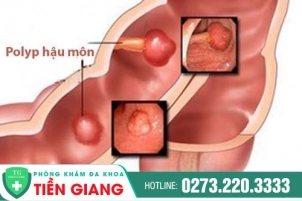 Triệu Chứng Nhận Biết Và Cách Chữa Polyp Hậu Môn An Toàn
