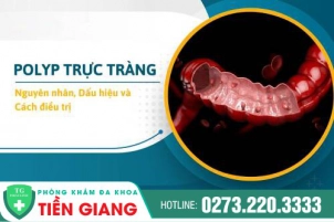 Polyp Trực Tràng Có Nguy Hiểm Không? Tổng Quan Về Bệnh Polyp Trực Tràng Mà Bạn Nên Biết