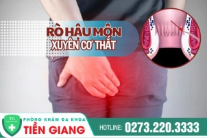 Rò Hậu Môn Xuyên Cơ Thắt Là Bệnh Gì? Nguyên Nhân Và Cách Điều Trị