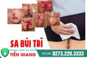 Búi Trĩ Là Gì? Biết Tất Tần Tật Về Sa Búi Trĩ