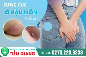Sưng Cục Ở Hậu Môn Là Dấu Hiệu Mắc Bệnh Lý Gì? Tìm Hiểu Phương Pháp Hỗ Trợ Điều Trị