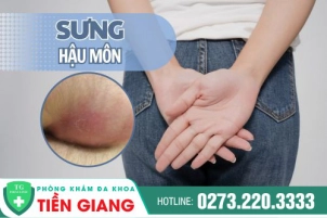Điều Trị Sưng Hậu Môn Bằng Các Phương Pháp Tiên Tiến