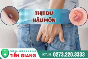 Thịt Dư Hậu Môn Là Dấu Hiệu Bệnh Gì? Nguyên Nhân Và Giải Pháp