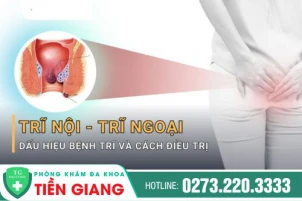 Dấu hiệu bệnh trĩ là gì? Mách bạn phương pháp chữa trĩ an toàn, hiệu quả