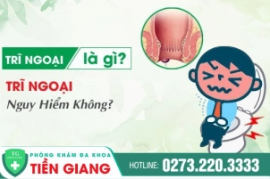 Trĩ Ngoại Là Gì? Nguy Hiểm Của Bệnh Trĩ Ngoại Mà Người Bệnh Cần Phải Biết