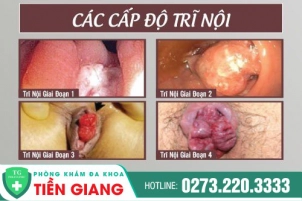 Trĩ Nội Là Gì? Nguyên Nhân Bị Trĩ Nội Và Cách Điều Trị