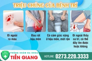 Triệu Chứng Mắc Bệnh Trĩ Và Các Biến Chứng Khó Lường